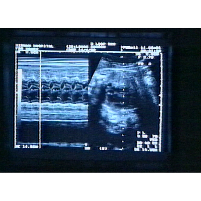 News file: ultrasound